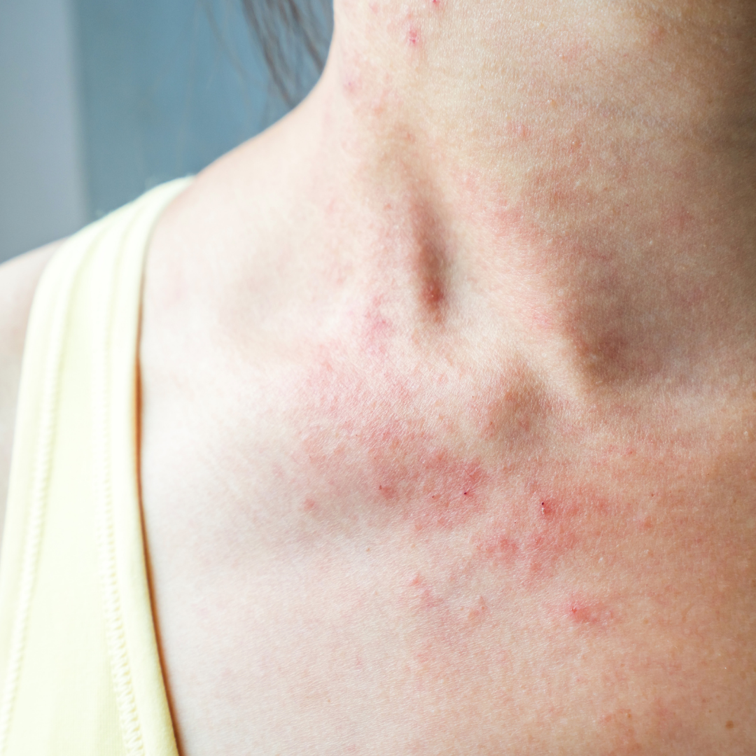 Eczema Daily Management Tips